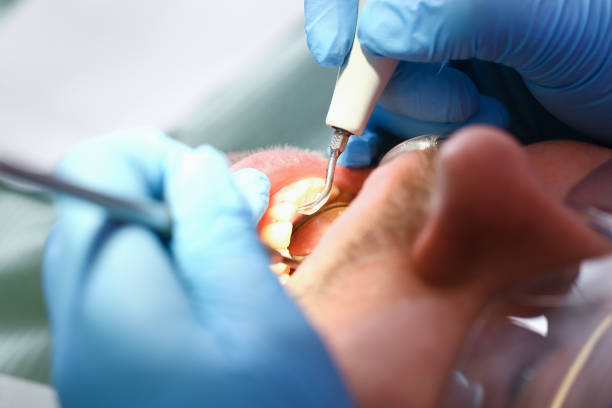 Best Emergency Tooth Extraction in Duluth, WA